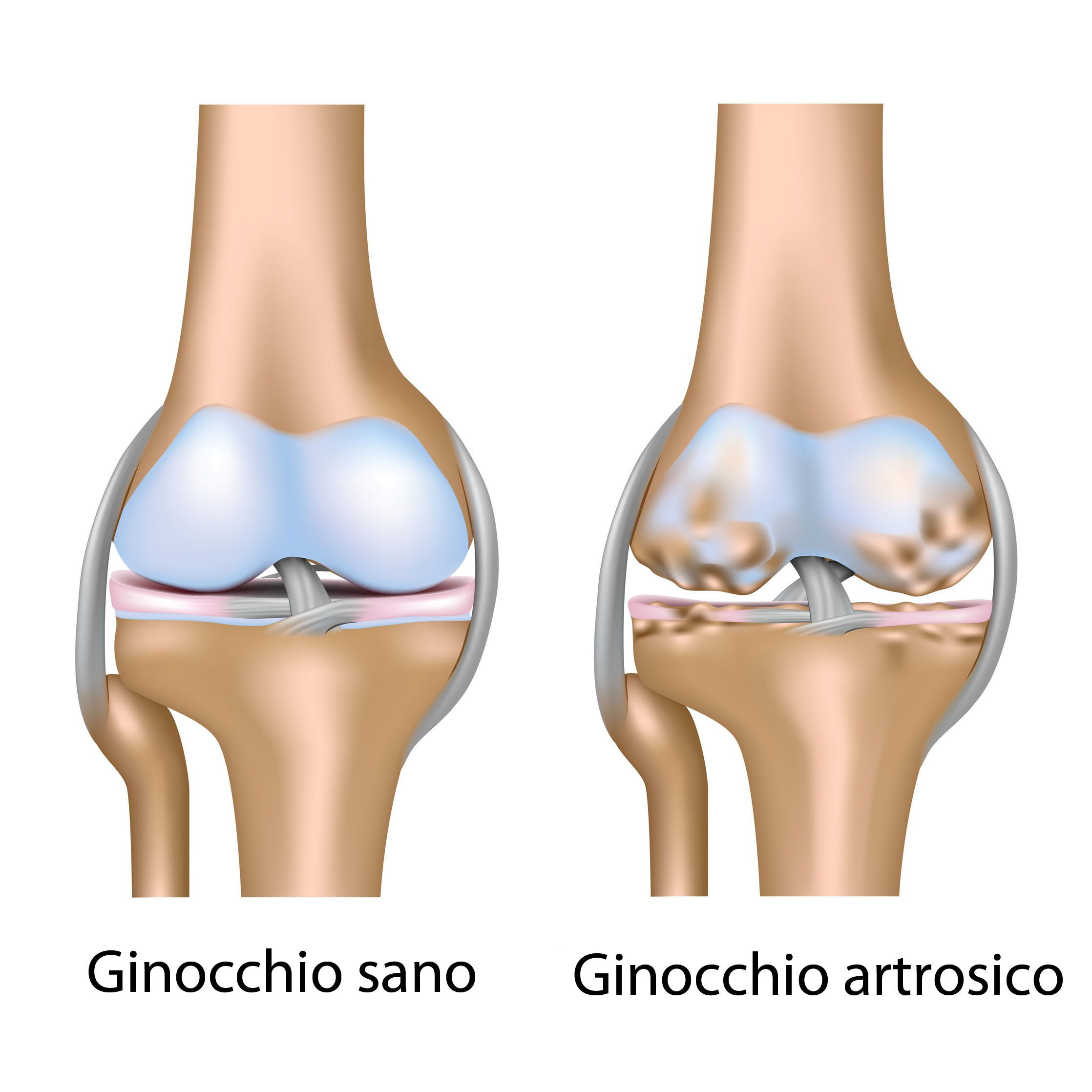 Ginocchio-sano-e-artrosico